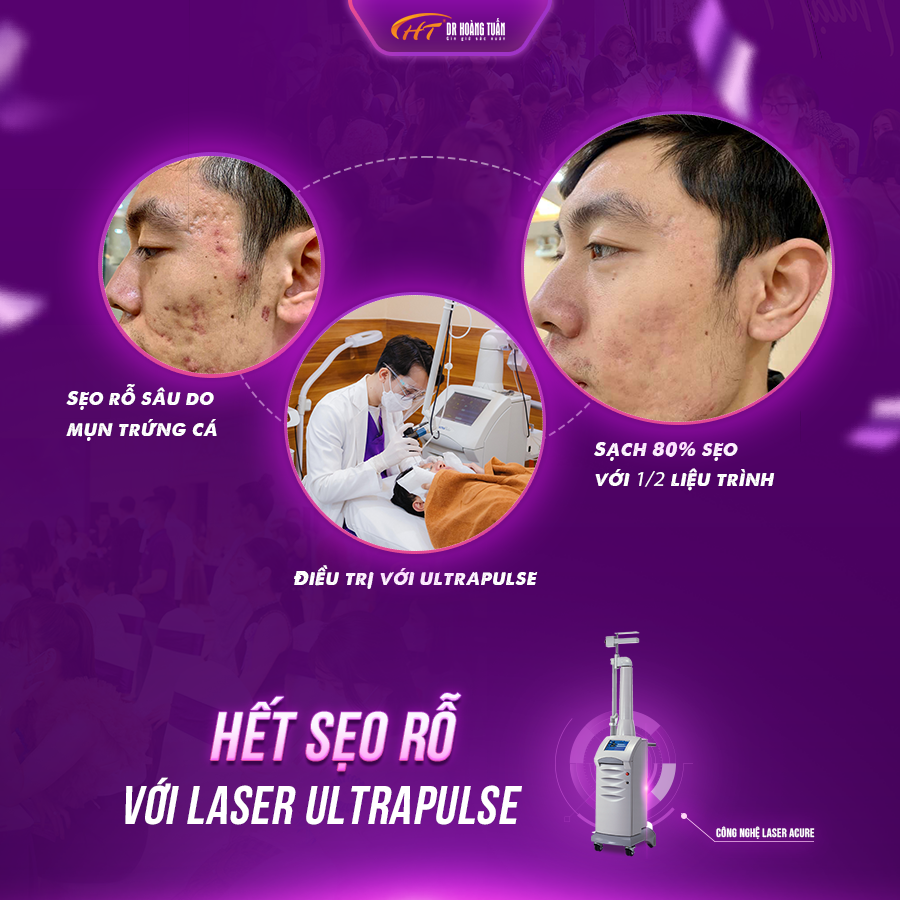trị sẹo rỗ bằng cách nào tốt nhất